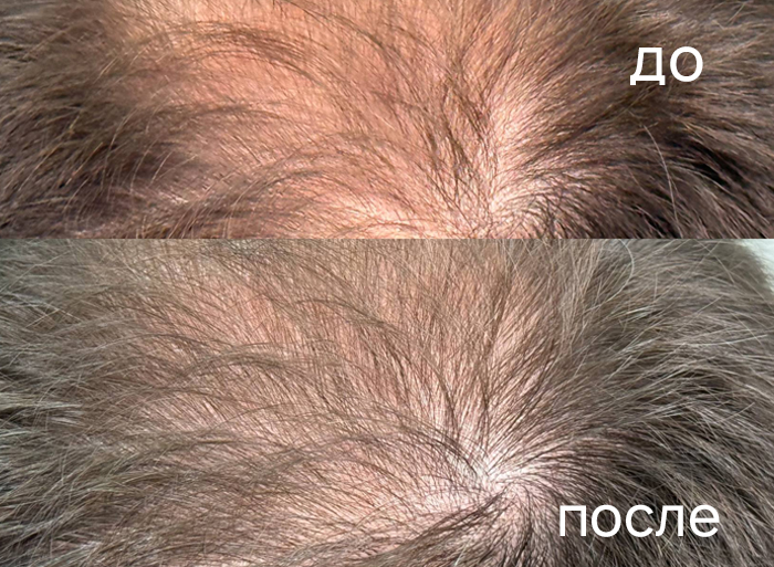 Волосистая часть головы до и после SkinHale